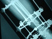 2-surgery