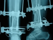 2-surgery