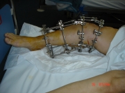 5-surgery