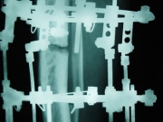 6-surgery